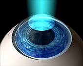 Dr. Barry G. Chaiken, M.D. | PRK | Photorefractive keratectomy
