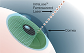 Dr. Barry G. Chaiken, M.D. | AdvancedVue™ | LASIK