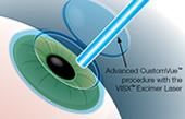 Dr. Barry G. Chaiken, M.D. | AdvancedVue™ | LASIK